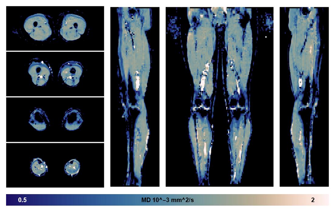 IVIM corrected whole leg muscle mean diffusivity obtained from diffusion tensor imaging.